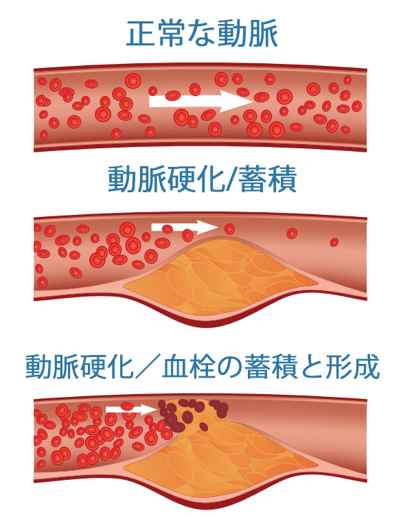 atherosclerosis.jpg